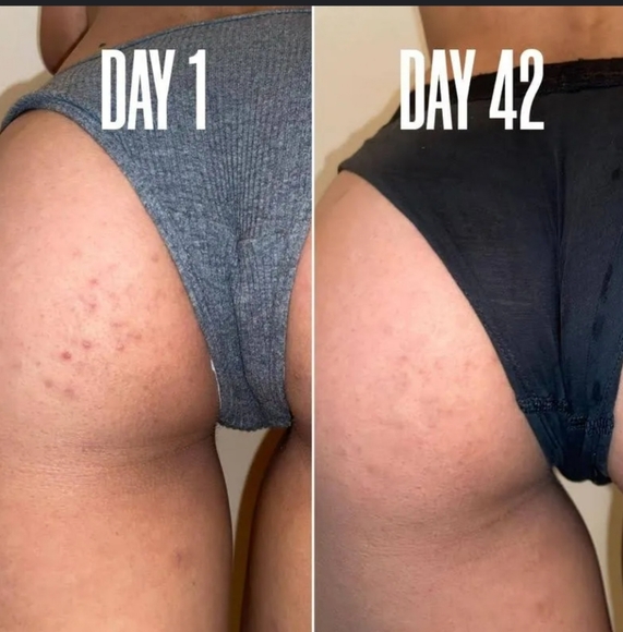 NWOB $48 Maelys Cosmetics B LUCID Targeted Body Acne Gel - Picture 6 of 10